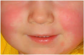 Image result for vyrážka u dětí