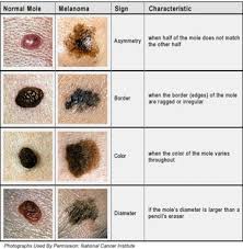 These photos show examples of melanoma, but it can look different on different folks. Malignant Melanoma The Mole In The Skin Hubpages