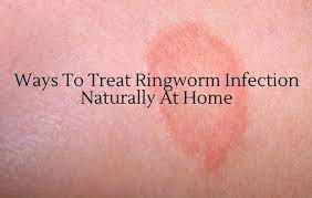 Ways To Treat Ringworm Infection Naturally At Home Ringworm Treating Ringworm Fungal Infection Skin