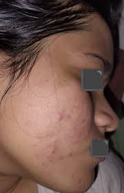 What should I do? 6+years with acne. I'd like to hear your suggestions and  opinions about what might be the problem.