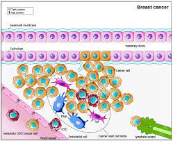 Once your liver and kidney gets overwhelmed wi. Formation And Dispersion Of Breast Cancer With Regard To The Cancer Download Scientific Diagram