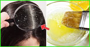 Then you will be provided with the opportunity to retain the good looks of your hair for a longer duration of time. 15 Effective Hair Masks For Dandruff