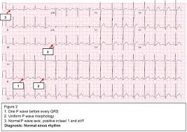 A Pocket Guide To Common Arrhythmias | Ppt