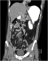 Image result for Midgut Volvulus