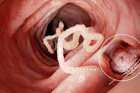 Dokter pun kaget ketika melihat ukuran cacing parasit yang ada dalam perut wanita ini. Jangan Menyepelekan Cacingan Anemia Sampai Kematian Menjadi Risikonya Semua Halaman National Geographic