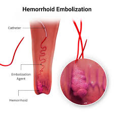 Image result for hemoroid human