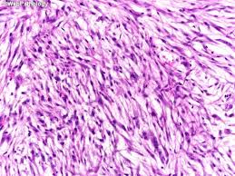 Image result for Leiomyosarcoma