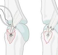 Collateral ligament reattachment for Articular fracture of ...