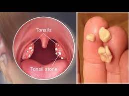 How are tonsil stones diagnosed? Pin On Zdorove