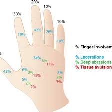 He didn't do the palm job technique. Percentage Of Injuries In The Fingers Mid Palm First Web Space Download Scientific Diagram