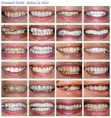 We did not find results for: Crooked Or Crowding Teeth Treatment Before After Photos