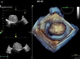Coronary Artery Arrangement In Patients With Tof. Parasternal... | Download  Scientific Diagram