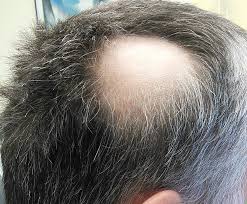 Alopecia totalis — total loss of the hair on the scalp. Xconomy With Fda S Eye On Jak Drugs Concert Moves One Ahead For Hair Loss