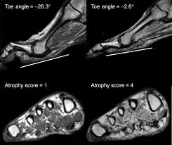 The intrinsic foot muscles comprise four layers of small muscles that have both their origin and insertion attachments within the foot foot muscles mri. Role Of Intrinsic Muscle Atrophy In The Etiology Of Claw Toe Deformity In Diabetic Neuropathy May Not Be As Straightforward As Widely Believed Diabetes Care