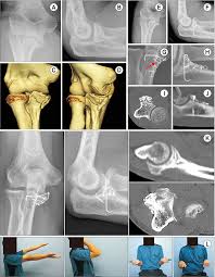 Image result for Coronoid Process Fracture