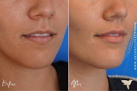 You can probably answer it yourself! Dermal Fillers With Before After Photos Skin By Lovely
