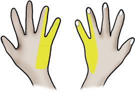 Una anastomosis puede, por ejemplo, conectar dos vasos sanguíneos, o puede conectar las secciones sanas del colon o el recto después de que se haya extirpado quirúrgicamente una porción. Entrapment Syndromes Of The Ulnar Nerve Musculoskeletal Key