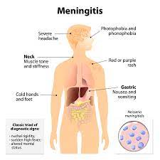 Consult a doctor for medical advice. The Many Causes Of Meningitis