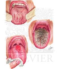 Image result for Fissured tongue