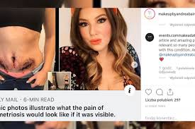 Endometrioza este o afectiune cu frecventa mare la femeile tinere si este una dintre principalele cauze de infertilitate feminina. Endometrioza Kobiety Nie Potrafily Opisac Swojego Bolu Postanowily Go Pokazac