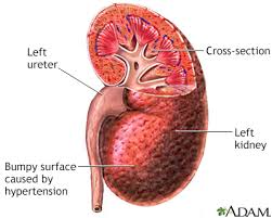 Image result for Hypertension