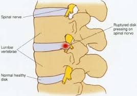 Kebanyakan rawatan ditujukan untuk memulihkan semula warna kulit. My8vertising Pencetus Informasi Di Hujung Jari Rawatan Radiofrequency Intradiscal Idrfdd Bagi Penyakit Cakera Tergelincir Atau Slipped Disc Alternatif Kepada Pembedahan