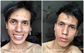 The oed records several suggested etymologies. Hilangkan Parut Chicken Pox Untuk Orang Dewasa Jejakakaula