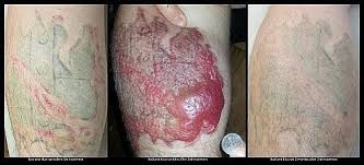 Lasers remove tattoos by breaking up the smaller tattoos will require fewer pulses while larger ones will need more to remove them. Blisters After Laser Tattoo Removal Treatments Vanishdfw Laser Tattoo Tattoo Removal Laser Tattoo Removal