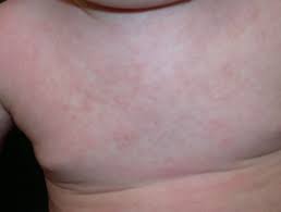 Rosélia (roselia en anglais) est le pokémon n°315 de type plante / poison. Roseola Dermnet Nz