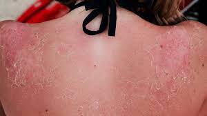 Maybe you would like to learn more about one of these? 5 Signs You Have Sun Poisoning