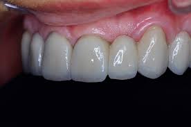Acest lucru este valabil mai ales pentru pacientii care sufera de retractie gingivala sau pentru cei care au gingii subtiri pentru ca, in timp, gingia dezveleste metalul folosit ca suport pentru lucrare. ReconstrucÈ›ia Arcadei Maxilare Cu Lucrare CeramicÄƒ Pe Suport Metalic Cabinet Stomatologic