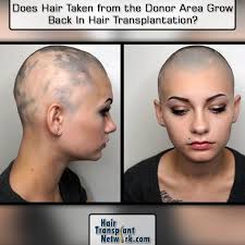 Learn more about how long it might take for your hair to grow back, how it may look and feel different when it does, and how to care for it Does Hair Taken From The Donor Area Grow Back After Hair Transplantation Hair Loss Cure Help Hair Loss Reduce Hair Loss