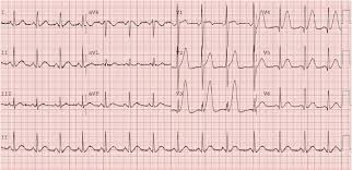 Image result for Hyperkalemia Management