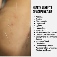 Image result for Acupuncture