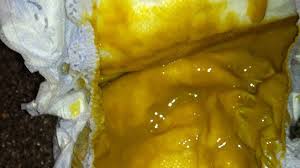 Acute diarrhea occurs for less than a total of 3 weeks, whereas if it lasts longer than 3 weeks, it is termed as chronic diarrhea. Mucus In Baby Poop Breastfed Teething Pictures And More