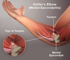 They have not been found in other mammals and man. How Can Physical Therapy Help My Golfer S Elbow Medial Epicondylitis Respire Physical Therapy