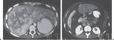 The Budd Chiari Syndrome Radiology Key