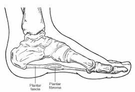 Giant cell tumors are commonly removed through surgery. Plantar Fibroma Treatment Of Plantar Fibroma Foot Health Facts Foot Health Facts