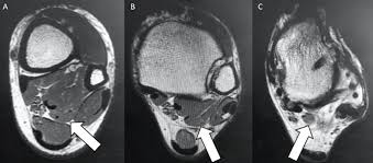 Mri with hardware in foot? When The Presence Of A Flexor Hallucis Accessory Longus Contributes To Chronic Foot Pain With Standing Podiatry Today