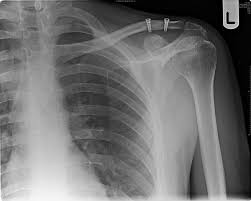So far we have managed over 6000 patients using. Acromioclavicular Joint Injuries Acj Yorkshire Shoulder Clinic