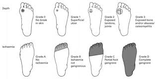 A deep foot ulcer may be a crater that extends through the full thickness of the skin. Diabetic Foot Ulcers Foot Ankle Orthobullets