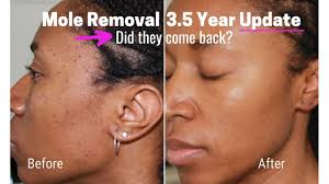 Here in this video i talk about how to get rid of beauty marks on face. How To Get Rid Of Moles And Dark Spots Fast Dpns Youtube