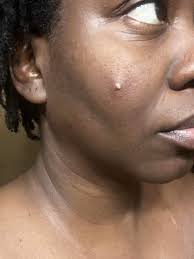 How to get rid of dark spots and scars