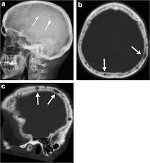 Multiple myeloma is the second most common type of blood cancer after leukemia. Radiological Review Of Skull Lesions Insights Into Imaging Full Text