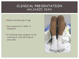 Image result for Galeazzi Sign