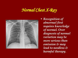 What it means for genes to be linked. Chest X Ray In Common Respiratory Diseases Ppt Download