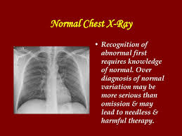 In cases of tuberculosis or tumor). Chest X Ray In Common Respiratory Diseases Ppt Download