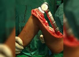 When these cancers in the bone are looked at under a microscope, they look like the tissue they came from. Bone Cancer Symptoms Causes Diagnosis And Treatment