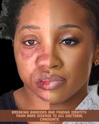 stevens-johnson syndrome