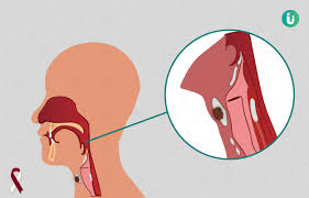 However, any of these can be caused by other problems as well. Throat Cancer Symptoms Causes Treatment Medicine Prevention Diagnosis